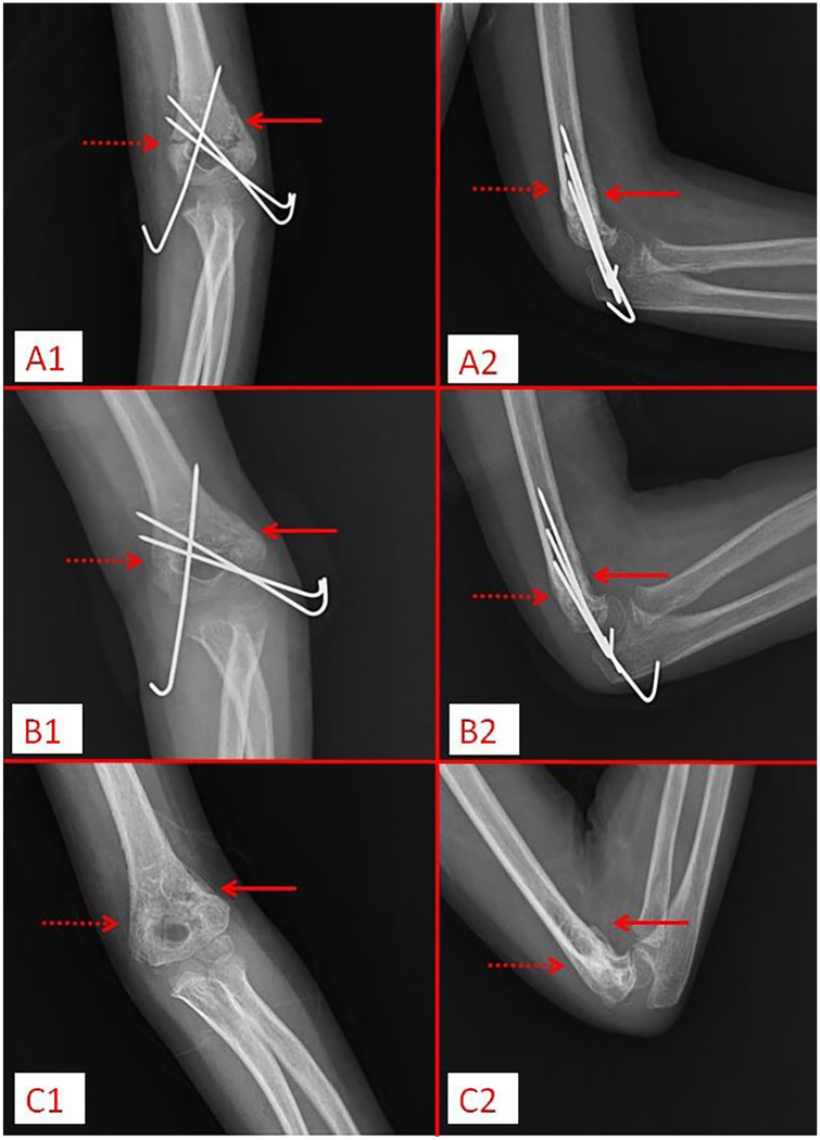 Reliability of radiographic union score and correlation of clinical outcomes in children operated for supracondylar humerus fracture: A prospective study.