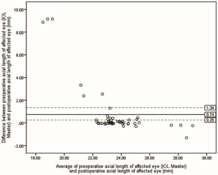 Optimizing axial length estimation for intraocular lens power calculation in phacovitrectomy for macula-off retinal detachment.