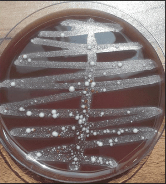 Detection and quantification of <i>Fusobacterium nucleatum</i> and <i>Porphyromonas gingivalis</i> in salivary samples of gutka and non-gutka users- 'A pilot study'.