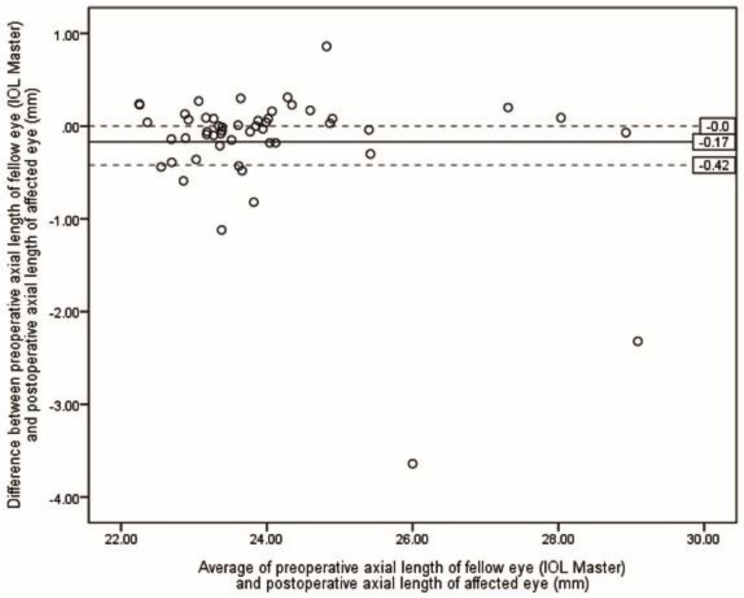Optimizing axial length estimation for intraocular lens power calculation in phacovitrectomy for macula-off retinal detachment.