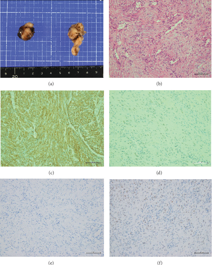 A Rare Case of Uterine-Origin Vulvar Leiomyoma Occurring in a Juvenile Girl: Case Report and Literature Review.