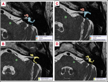 Utility of MRI quantitative analysis in assessment of audio-vestibular impairment.