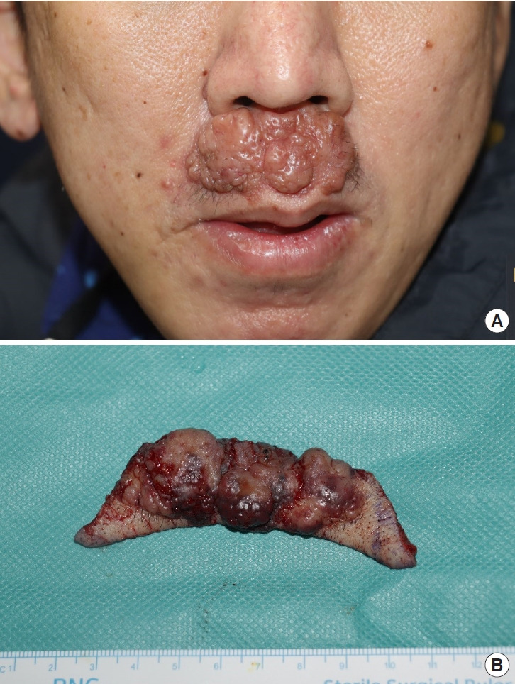Atypical elastofibroma of the philtrum mimicking rosacea: a case report and literature review.