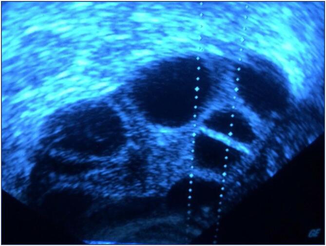 An assessment of total antioxidant and oxidant parameters and their correlation with embryo quality in in-vitro fertilization patients.
