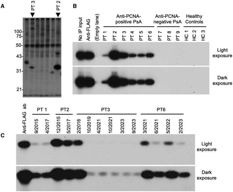 Anti-PCNA antibodies in psoriatic arthritis: a case-control study.