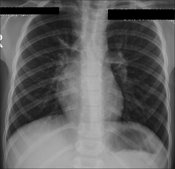 The effect of atlantoaxial stabilization on juvenile idiopathic scoliosis involving Chiari malformation and syrinx.
