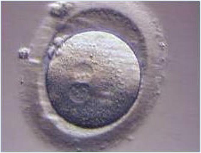 An assessment of total antioxidant and oxidant parameters and their correlation with embryo quality in in-vitro fertilization patients.