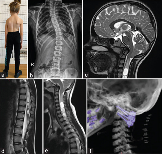 The effect of atlantoaxial stabilization on juvenile idiopathic scoliosis involving Chiari malformation and syrinx.