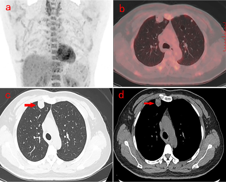 Multiple pulmonary mucinous cystadenoma with Ovarian-like stroma: a case report.