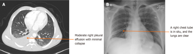 Time to resolution of radiologically detected hemothorax in trauma patients: A retrospective observational study.
