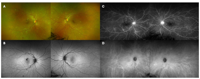 Bilateral acute multifocal retinitis and retinal vasculitis secondary to Rickettsia typhi infection.