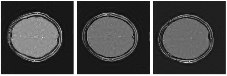 Rosette Trajectory MRI Reconstruction with Vision Transformers.