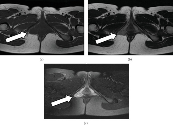 A Rare Case of Uterine-Origin Vulvar Leiomyoma Occurring in a Juvenile Girl: Case Report and Literature Review.