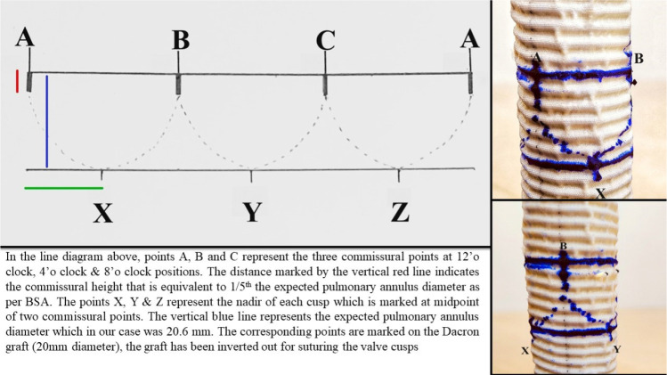 Reviving Duran's Approach to Pericardial Valve Reconstruction in the Pulmonary Position Within the Right Ventricle-to-Pulmonary Artery Conduit: A Compelling Case Report.