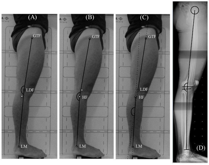 Concurrent Validity of Three Photogrammetric Methods for Assessing Knee Alignment in Sagittal Plane.