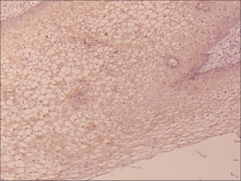 Desmoglein 1 and 3 as potential markers of occult lymph node metastasis in oral cancer.