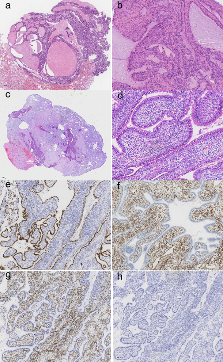Multiple pulmonary mucinous cystadenoma with Ovarian-like stroma: a case report.