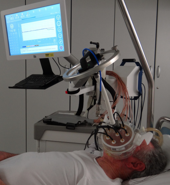 Durable response to nivolumab in combination with regional hyperthermia in a patient with PD-L1-negative metastatic head and neck squamous cell carcinoma.