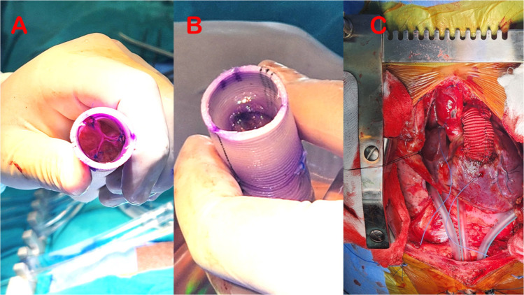 Reviving Duran's Approach to Pericardial Valve Reconstruction in the Pulmonary Position Within the Right Ventricle-to-Pulmonary Artery Conduit: A Compelling Case Report.