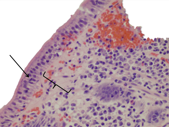 Coexisting Collagenous Sprue and Celiac Disease: A Case Report.