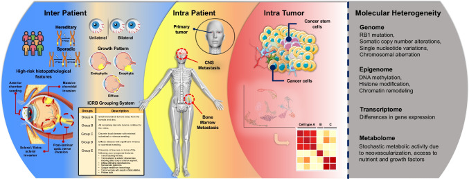 Tumor heterogeneity in retinoblastoma: a literature review.