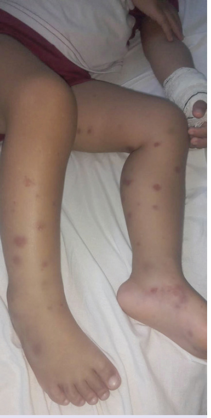 Henoch-Schonlein purpura successfully treated with a milk-free diet, vitamin D and C: First description.