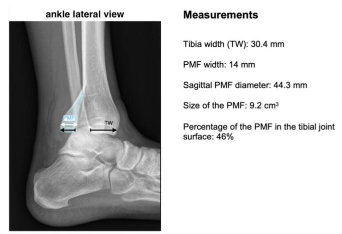 The medial clearspace is a risk factor for secondary dislocation following cast immobilization after closed reduction in closed ankle fracture dislocations.
