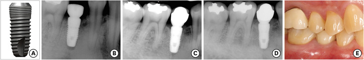 Long-term clinical and radiographic outcomes of a bone-level, 2-piece, internal connection implant system with coronal microthreads over 10 years of follow-up: a retrospective clinical study.