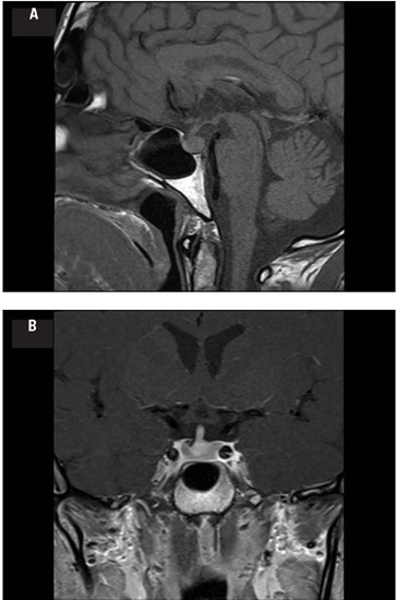 Arginine-vasopressin deficiency due to long COVID-associated infundibulo-neurohypophysitis.