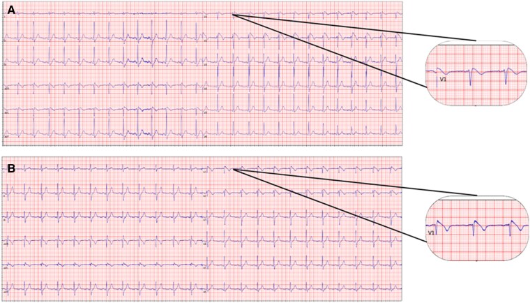 Synthetic electrocardiograms for Brugada syndrome: from data generation to expert cardiologists evaluation.