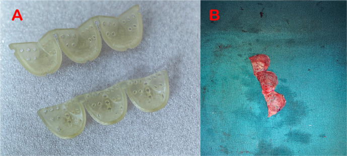 Reviving Duran's Approach to Pericardial Valve Reconstruction in the Pulmonary Position Within the Right Ventricle-to-Pulmonary Artery Conduit: A Compelling Case Report.
