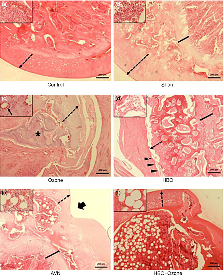 The effects of systemic ozone application and hyperbaric oxygen therapy on avascular necrosis of the femoral head: An experimental study in the vascular deprivation of the rat femoral head model.