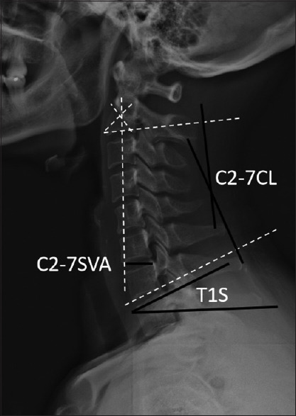 Parameter algorithm-driven optimization of surgical approaches: An investigation based on T1 slope minus C2-7 cervical lordosis in patients with cervical degenerative diseases.