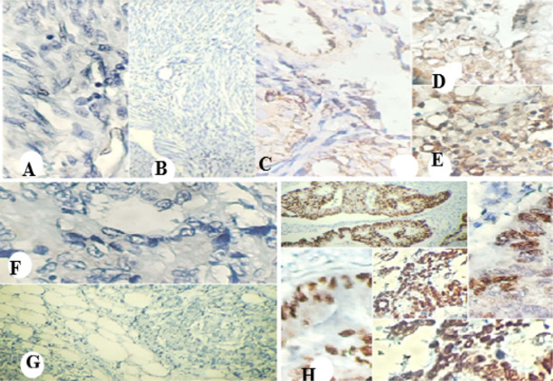 Presence and Interactions of <i>Entamoeba histolytica</i> Lectin and <i>p53</i> Protein in Colorectal Cancer.
