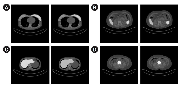 Development of automatic organ segmentation based on positron-emission tomography analysis system using Swin UNETR in breast cancer patients in Korea.