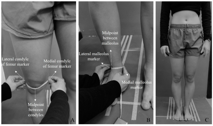 Concurrent Validity of Three Photogrammetric Methods for Assessing Knee Alignment in Sagittal Plane.