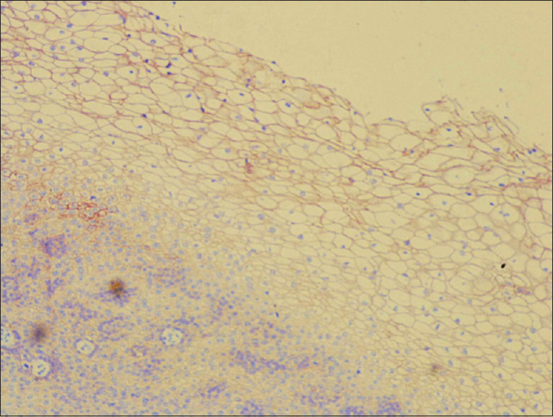 Desmoglein 1 and 3 as potential markers of occult lymph node metastasis in oral cancer.
