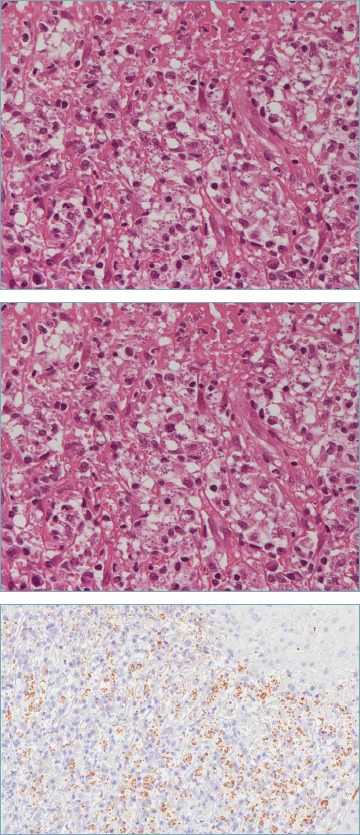 A tricky nasal polyp.