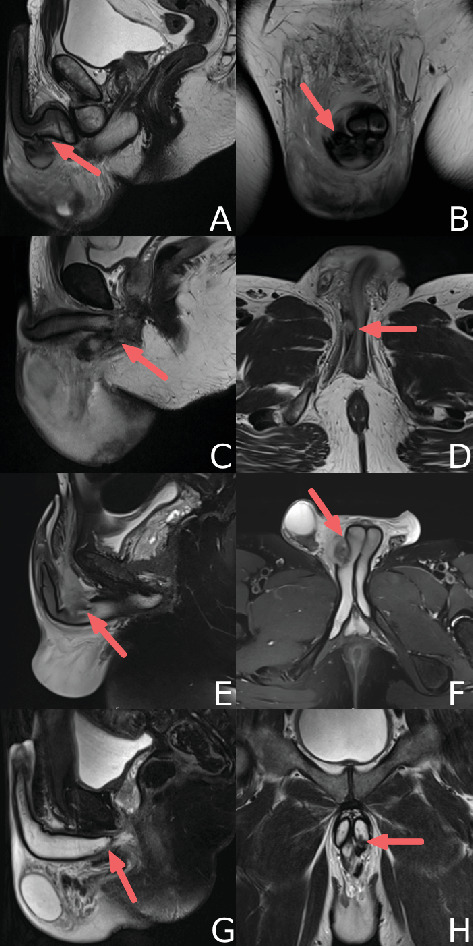Perineal Incision for the Surgical Management of Extremely Proximal Internal Penile Fractures-A Case Series and Review of Literature.