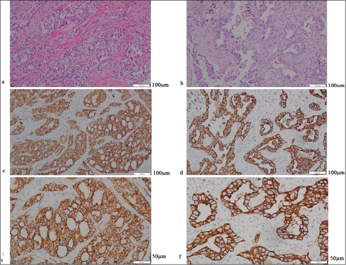 Expression and clinical significance of programmed cell death protein 1/programmed death-ligand 1 in non-small cell lung cancer patients with rare mutations of epidermal growth factor receptor gene: A retrospective cohort study.