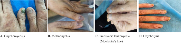 Onychomycosis among cancer patients undergoing chemotherapy in Tehran, Iran: a cross-sectional study.