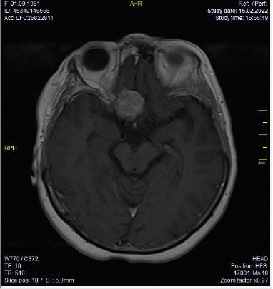Olfactory Groove Meningioma Compressing the Optic Chiasm and Optic Nerve: Improvement of Visual Functions by Surgical Intervention.