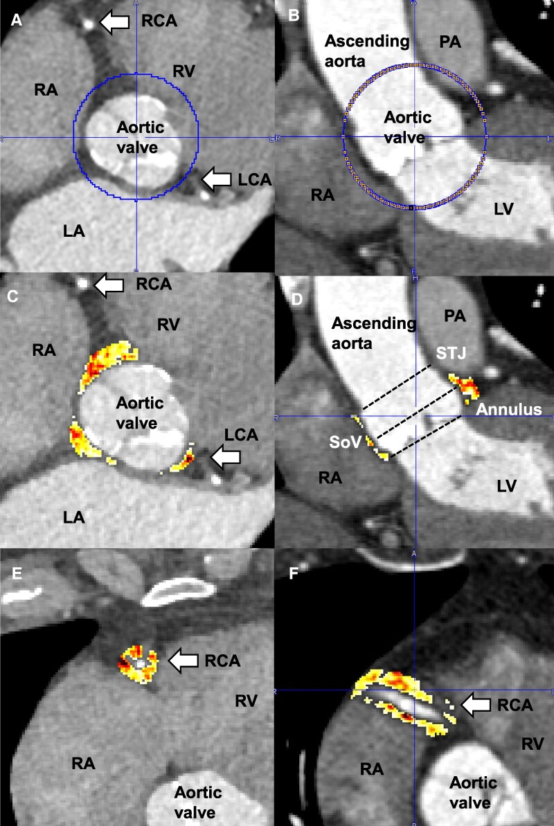Quantification of perivascular adipose tissue attenuation does not add incremental prognostic value in patients undergoing transcatheter aortic valve implantation.