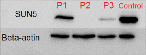 Novel SUN5 Mutation Associated with Acephalic Spermatozoa Syndrome: A Cross-sectional Study.