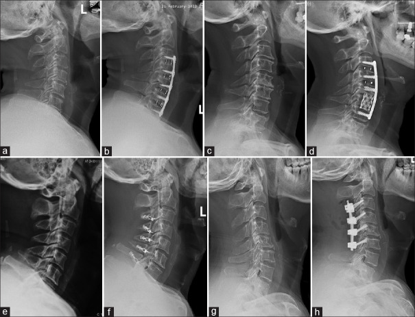 Parameter algorithm-driven optimization of surgical approaches: An investigation based on T1 slope minus C2-7 cervical lordosis in patients with cervical degenerative diseases.