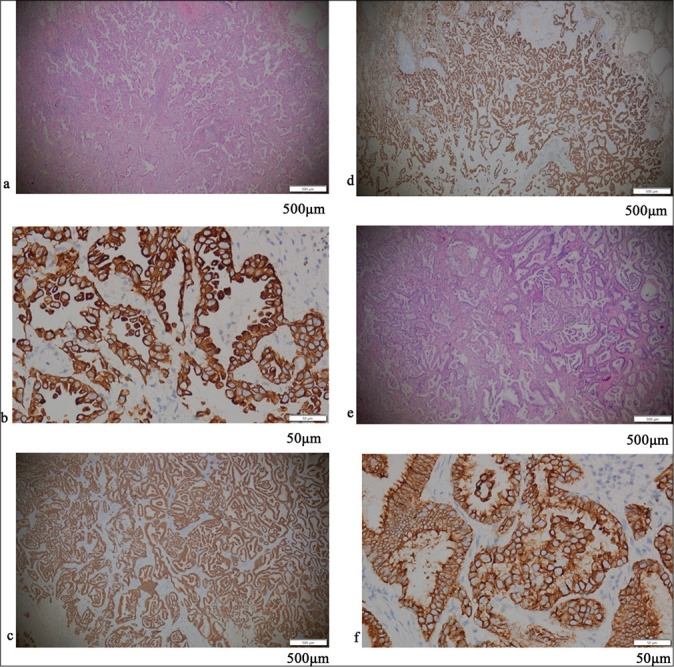 Expression and clinical significance of programmed cell death protein 1/programmed death-ligand 1 in non-small cell lung cancer patients with rare mutations of epidermal growth factor receptor gene: A retrospective cohort study.