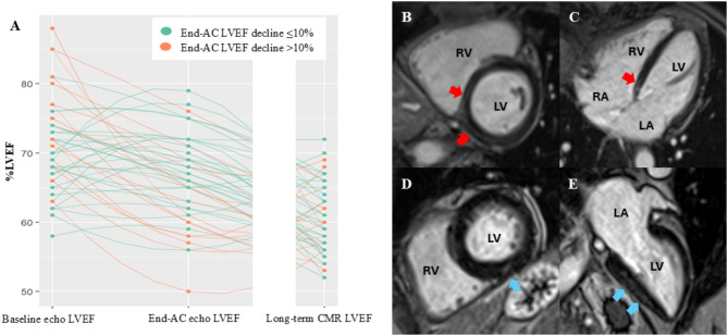 Long-term impact of anthracycline in early-stage breast cancer, bridging of MiRNAs profiler for early cardiotoxicity.