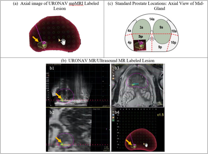 Evaluation of 3D ARFI imaging of prostate cancer: diagnostic reliability and concordance with MpMRI.