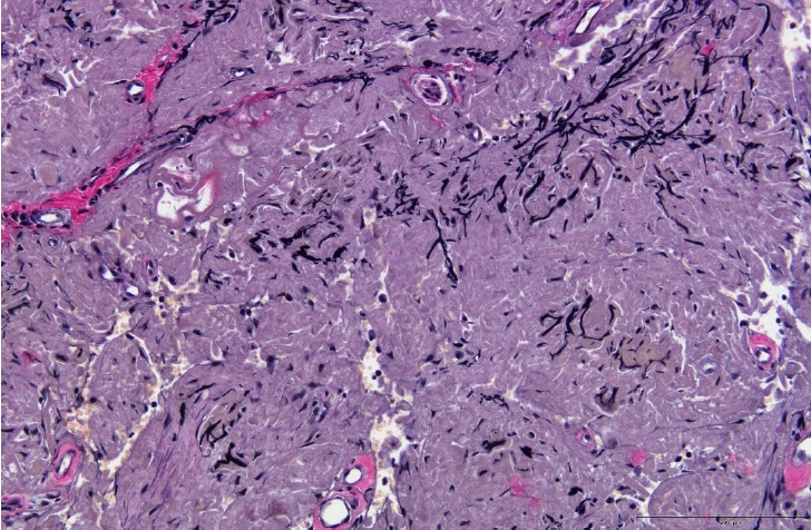 Atypical elastofibroma of the philtrum mimicking rosacea: a case report and literature review.