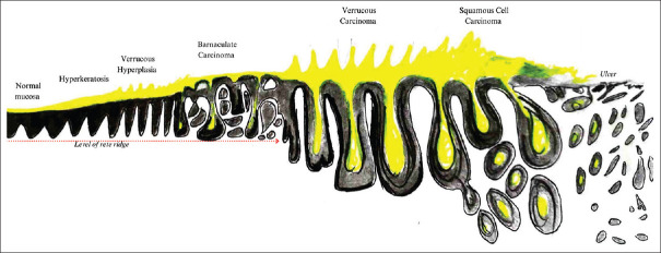 Barnaculate Carcinoma - A new terminology for the recognition of a histologically familiar entity.